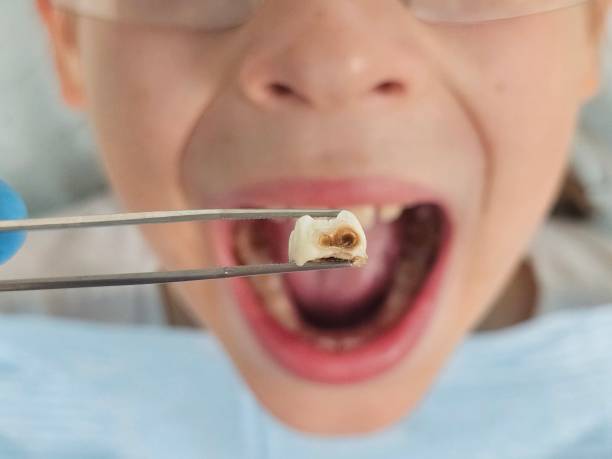 Best Broken or Cracked Tooth Emergency Dentist in Leander, TX