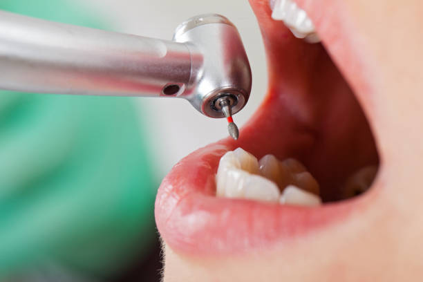 Best Emergency Root Canal Treatment in Leander, TX
